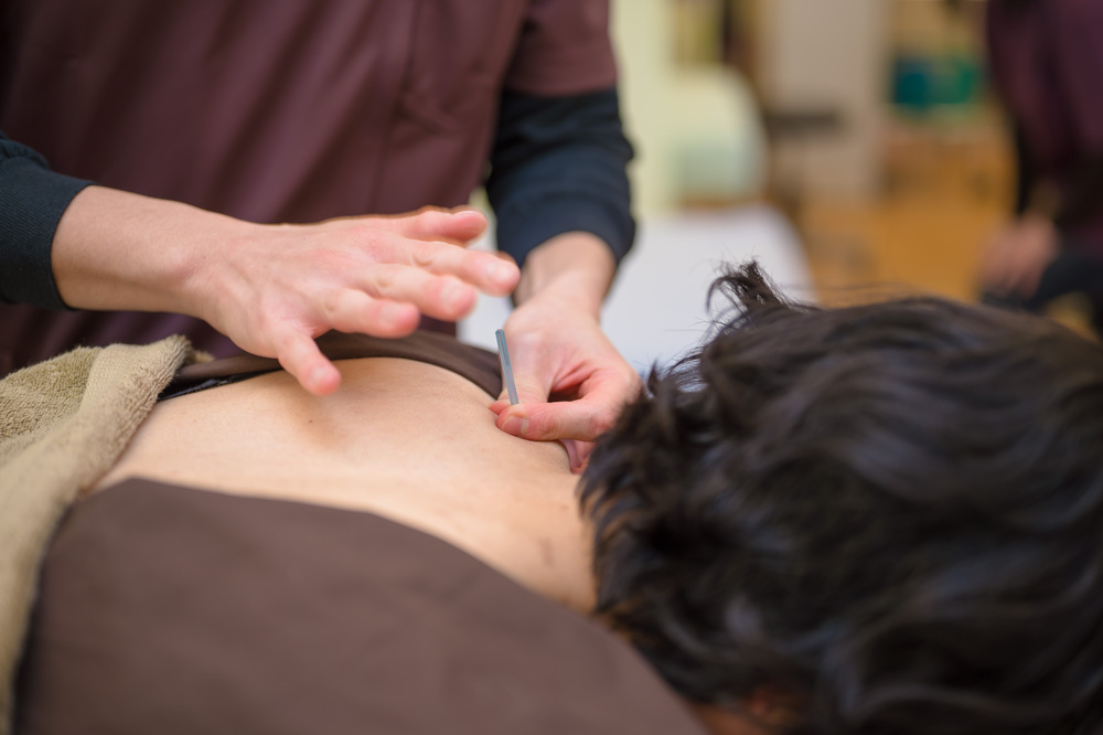 いのうえ鍼灸整骨院の肩こりトリガーポイント鍼治療