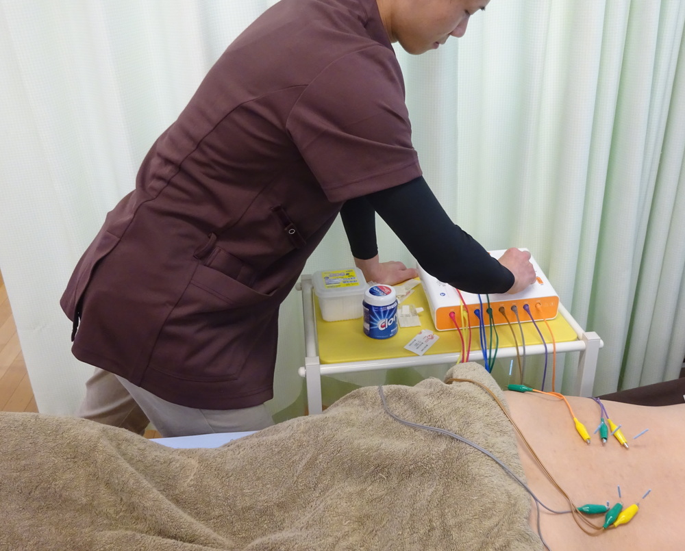 お尻の筋肉への鍼通電施術